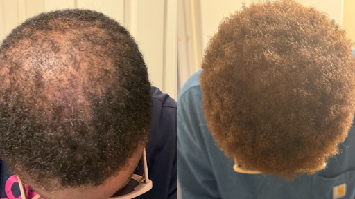 Before and after result